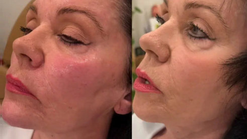 A woman shows her face with wrinkles before and after a facial treatment
