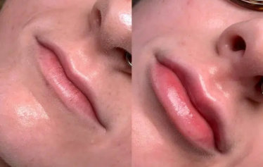 Before and after images of a lip lift procedure