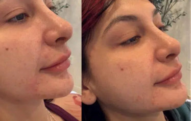 Woman's face showing acne before and after treatment