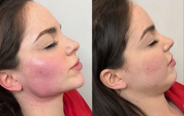 Before and after photos showing a woman with red skin