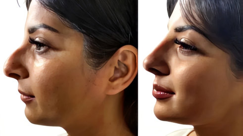 A woman’s face displays wrinkles before and a smoother appearance after receiving a facial treatment