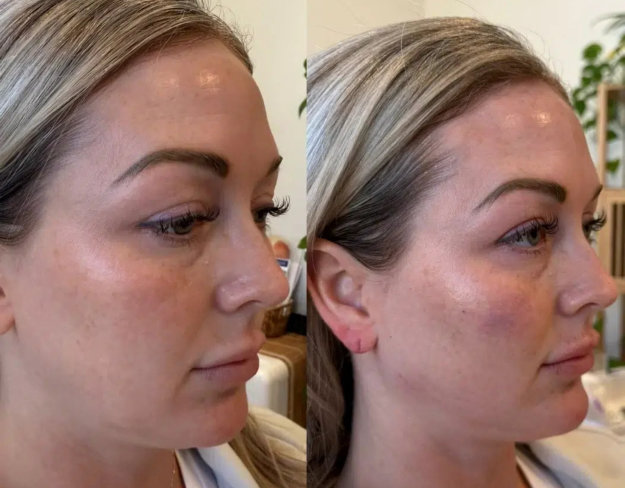 Before and after images of a woman's face