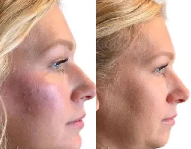Before and after photos showing a woman's face
